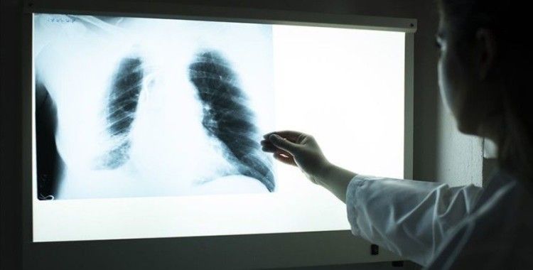 Akciğer hastalıkları koronavirüsün daha ciddi seyretmesine neden oluyor