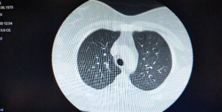 Koronavirüse yakalanan hastaların ciğerlerindeki dehşet veren görüntü