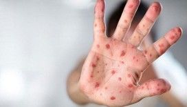 Maymun Çiçeği hastalığını 1 saatte saptayabilen PCR Tanı Kiti geliştirildi