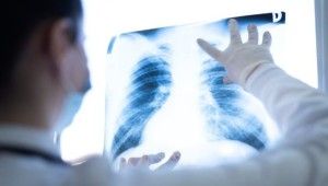 "Ciğerlerde kalan Covid-19 nodülleri akciğer kanseri başlangıcı olabilir"