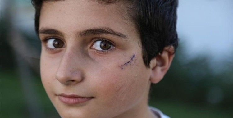 Silivri'de sahipsiz köpeğin saldırısına uğrayan çocuk yüzünden yaralandı