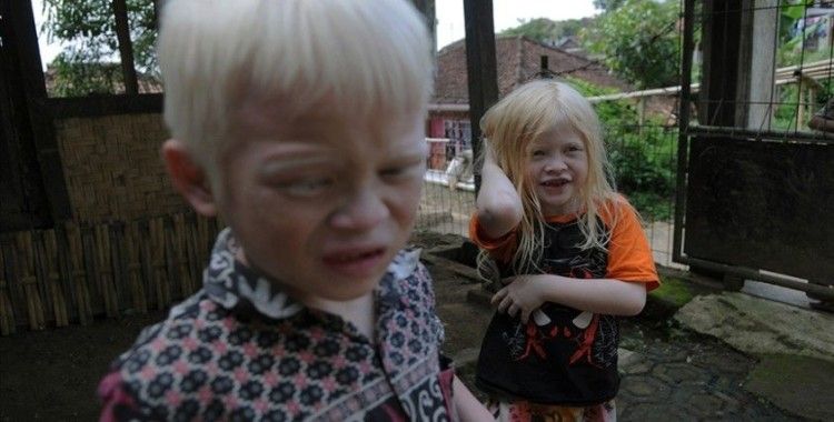 BM'ye göre, Kuzey Amerika ve Avrupa'da her 17 bin ila 20 bin kişiden biri albinizm hastası