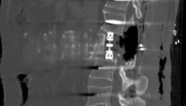 Bayburt’ta omur gövdesi çıkarılarak yapılan ameliyat başarıyla gerçekleşti
