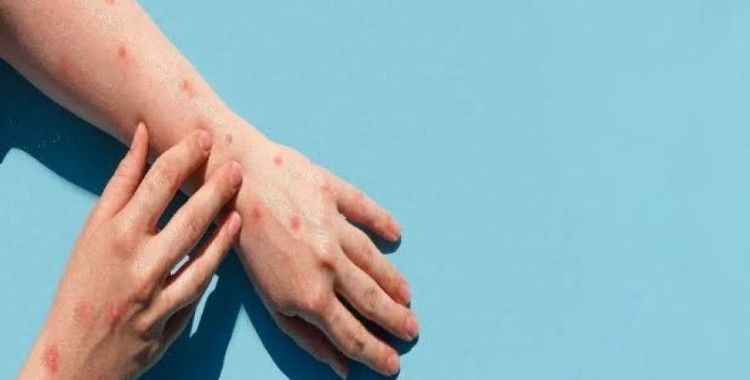 Nijerya'da difteri salgını yayılıyor: 406 kişi hayatını kaybetti